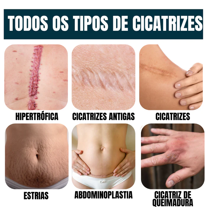 Gel Scar® 100% Advanced Gel - Para todos os Tipos de Cicatrizazes